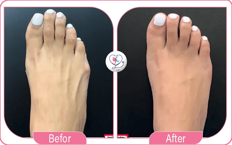 ما هي عملية تجميل أصابع القدم؟