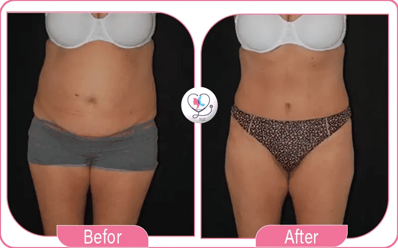 مميزات إجراء عملية شفط دهون الأرداف