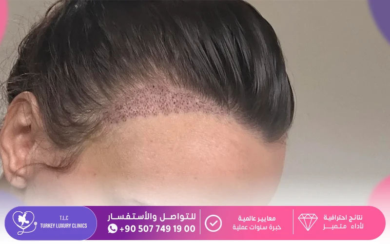 زراعة الشعر للنساء في تركيا