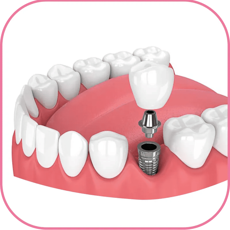 3D Printed Dental Implants Images describe