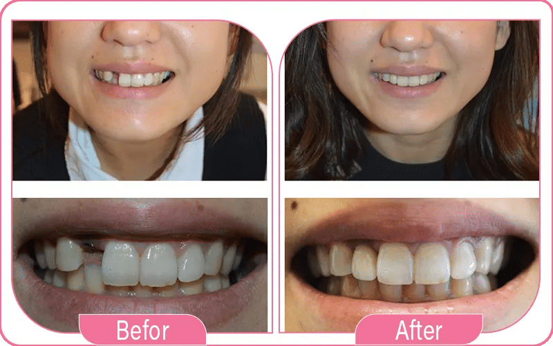 Single Tooth Dental Implant Before and After
