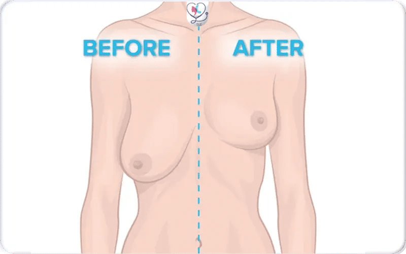 Chirurgie esthétique pour seins qui tombent