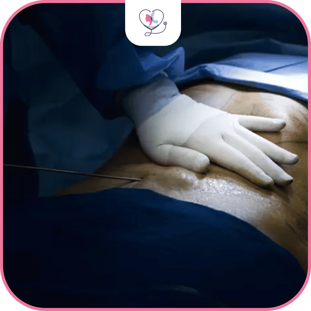 مخاطر عملية نحت عضلات البطن