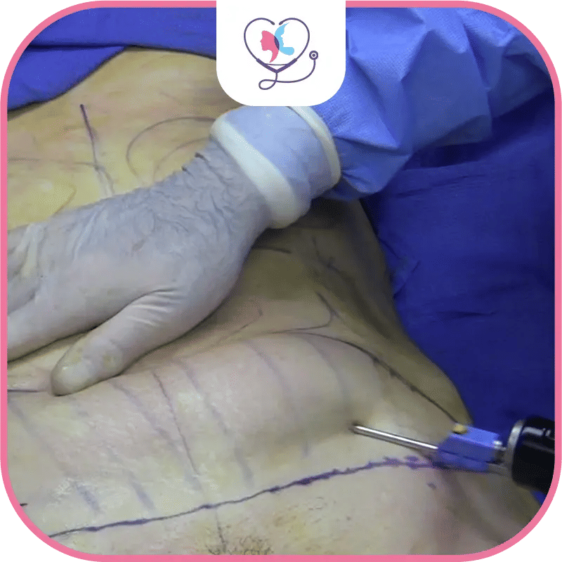 التورم والكدمات بعد شفط الدهون