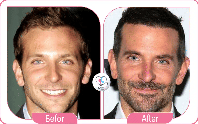 Bradley Cooper chirurgie ratée rumeur ou réalité