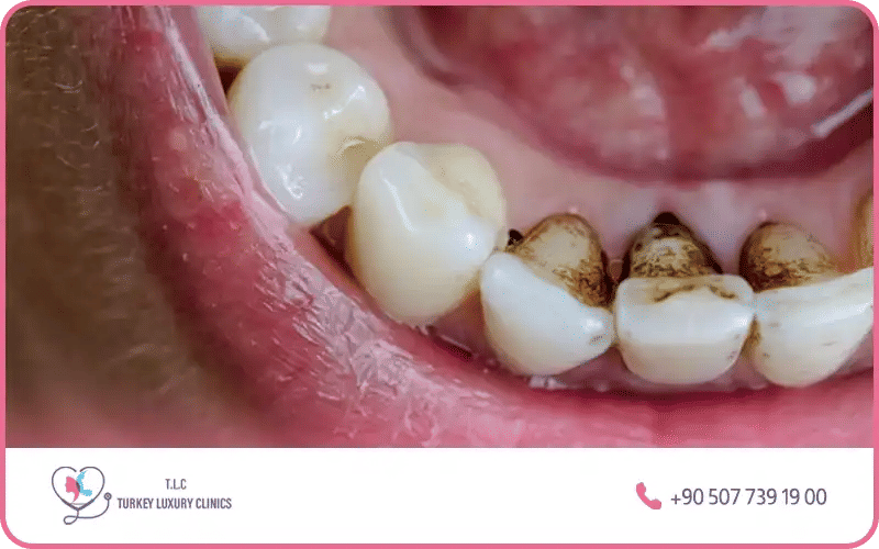 أنواع جير الأسنان