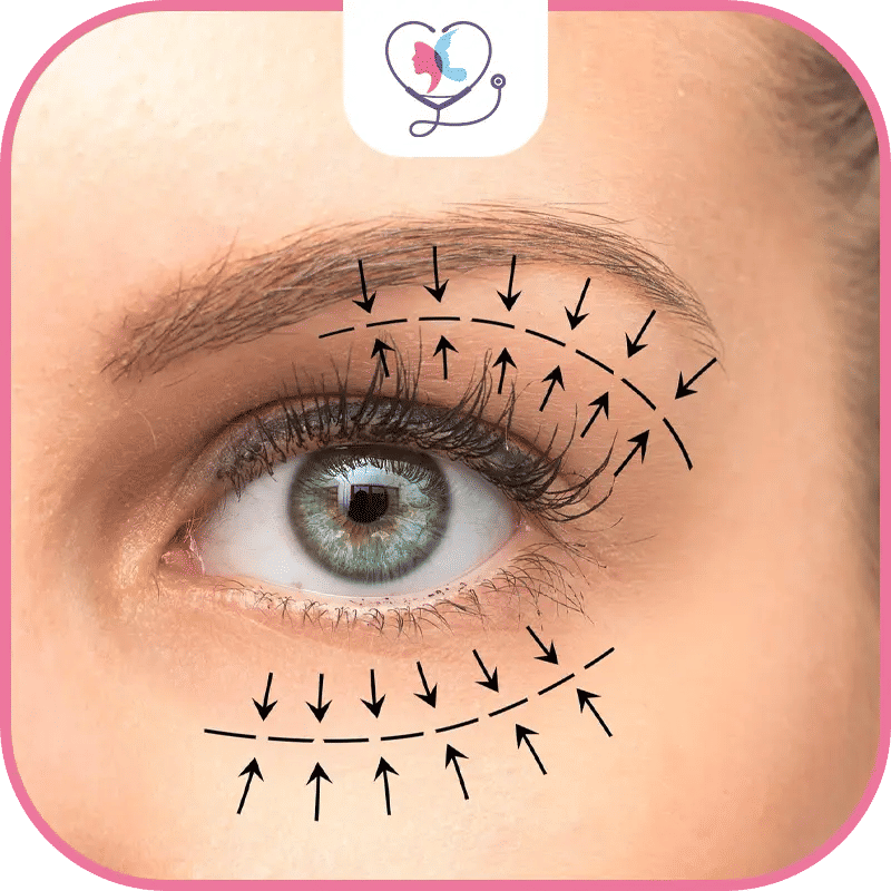 ماهي عملية رفع الحاجبين؟