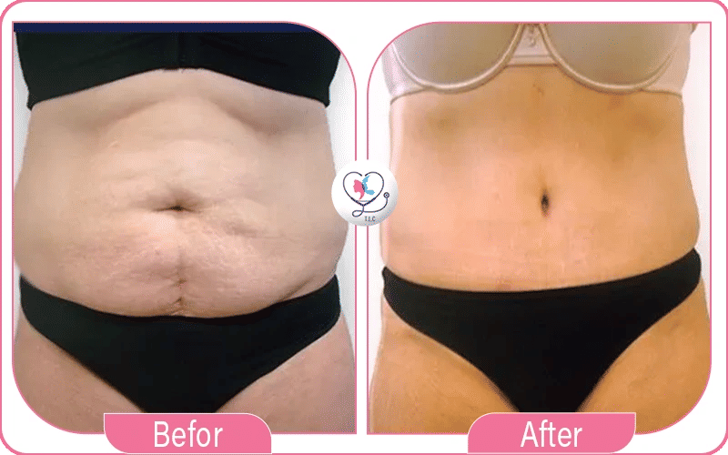 Stomach 360 lipo without tummy tuck before and after photos 2
