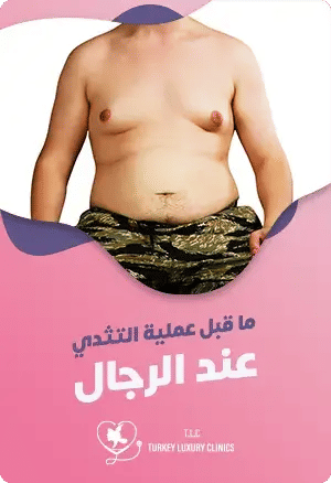  ما قبل عملية التثدي عند الرجالfeatured image