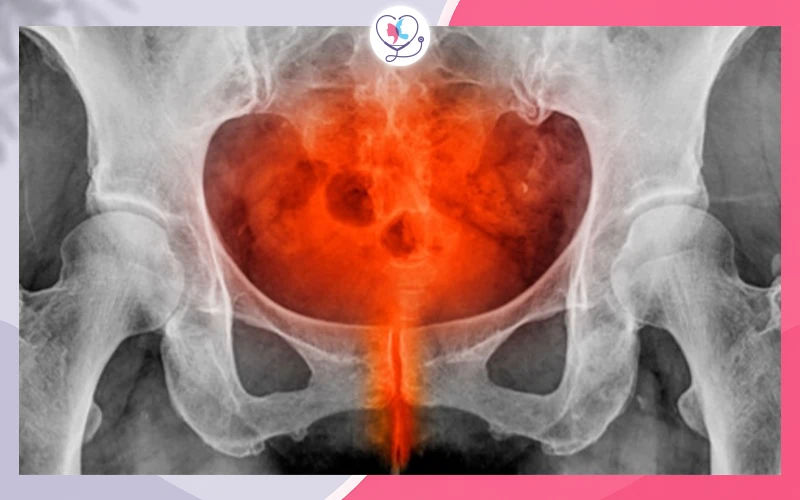 مرض التهاب الحوض (PID)