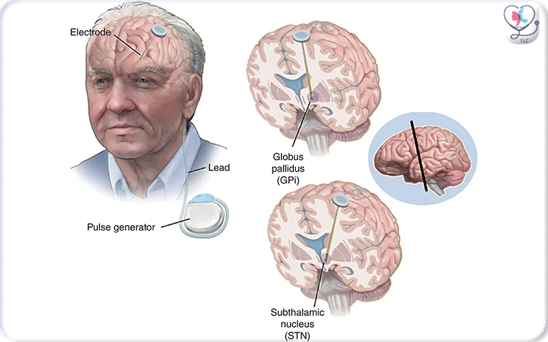 What is Deep Brain Stimulation Surgery? 4
