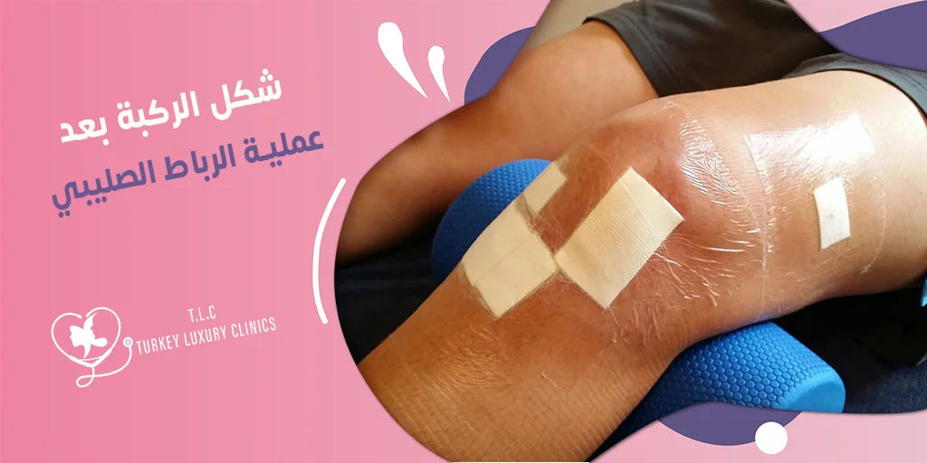شكل الركبة بعد عملية الرباط الصليبي: صور قبل وبعد
