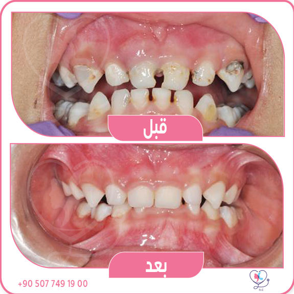 تسوس اسنان اطفال
