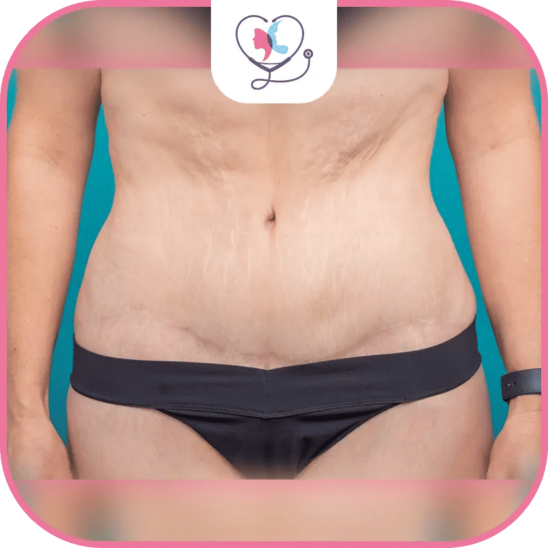 مدة الشفاء من عملية شد البطن