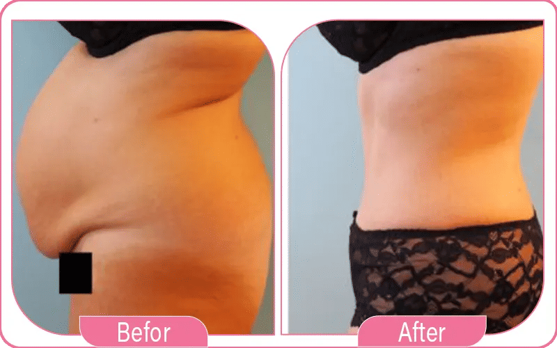 Les bénéfices de l’abdominoplastie en Turquie avant/après