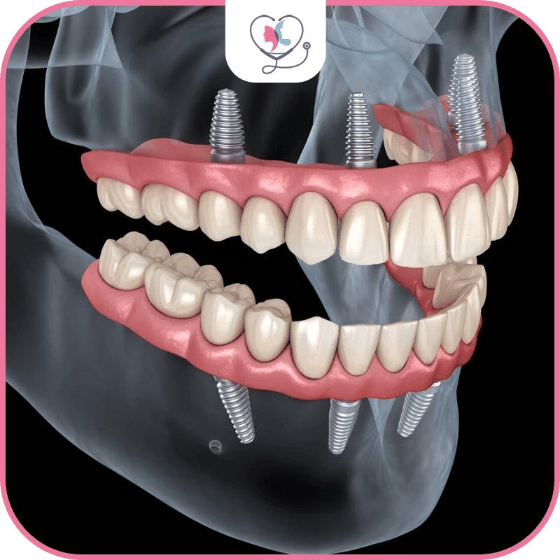 Exploring the Different Types of Dental Implants: Finding the Right Fit for You