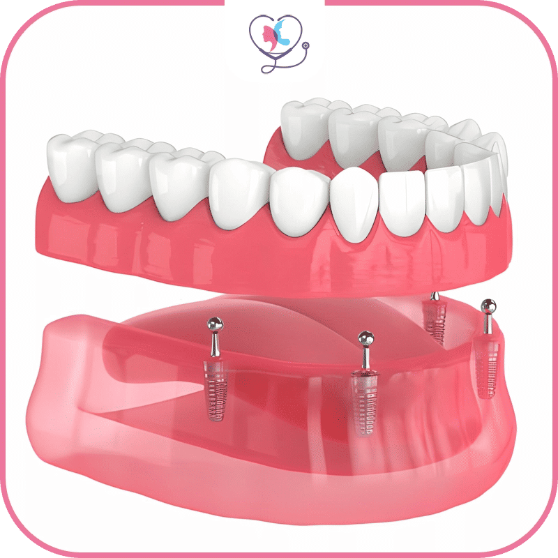 à-qui-convient-le-système-all-on-4-?