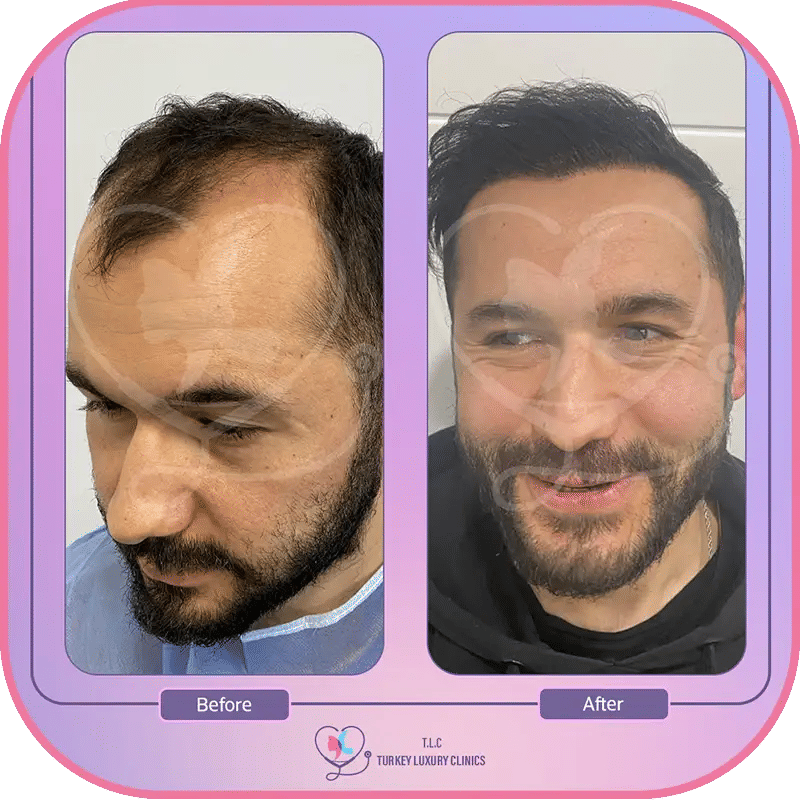 تجربتي مع زراعة الشعر في تركيا