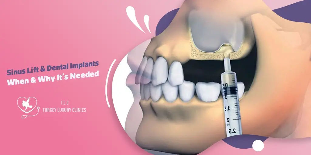 Sinus Lift and Dental Implants: When & Why It's Needed