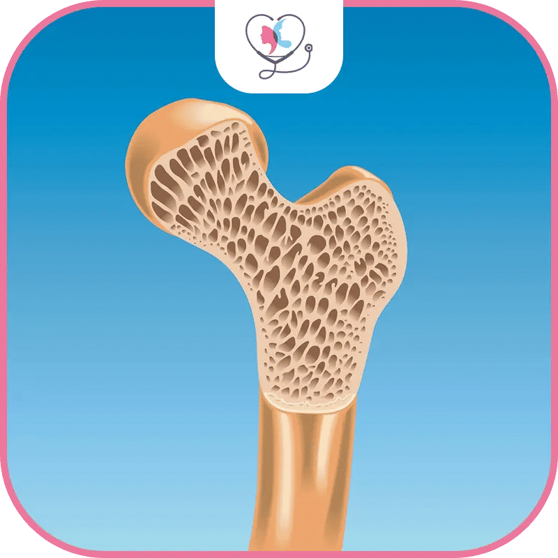 مخاطر الكسور الرياضية