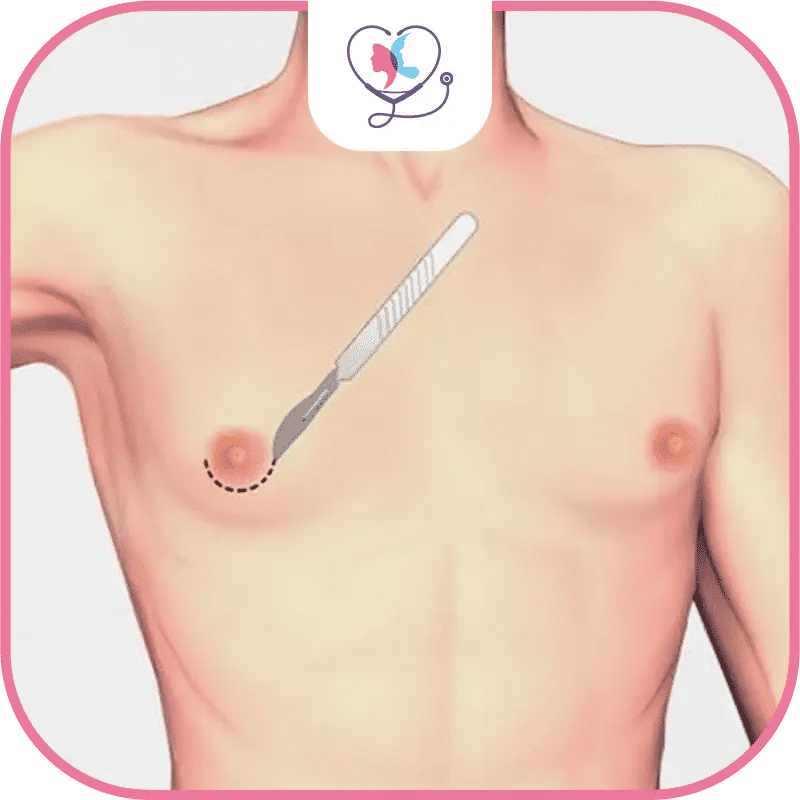 ماهي أضرار عملية التثدي للرجال؟