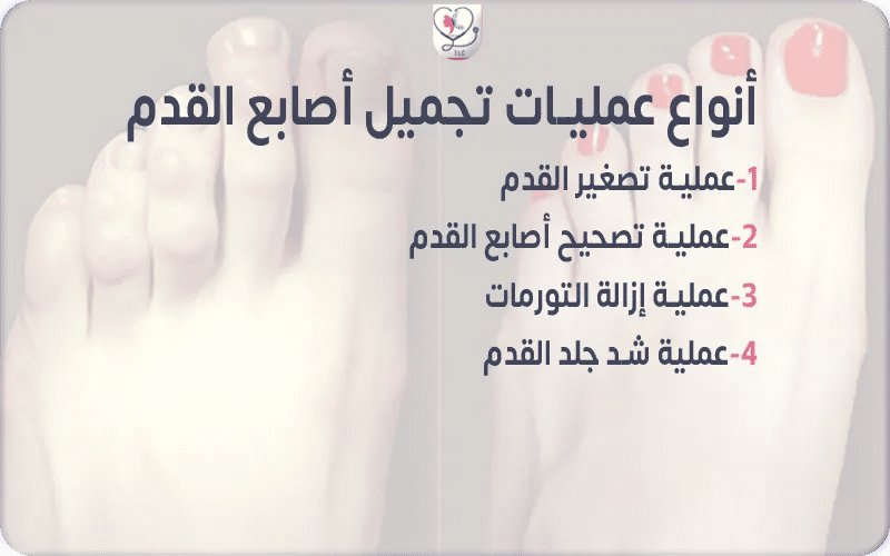أنواع عمليات تجميل أصابع القدم