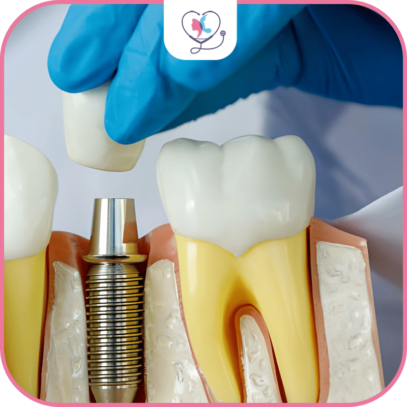 les-contre-indications-aux-implants-dentaires