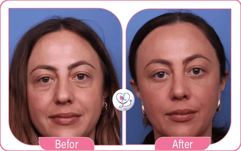 Blépharoplastie supérieure avant après