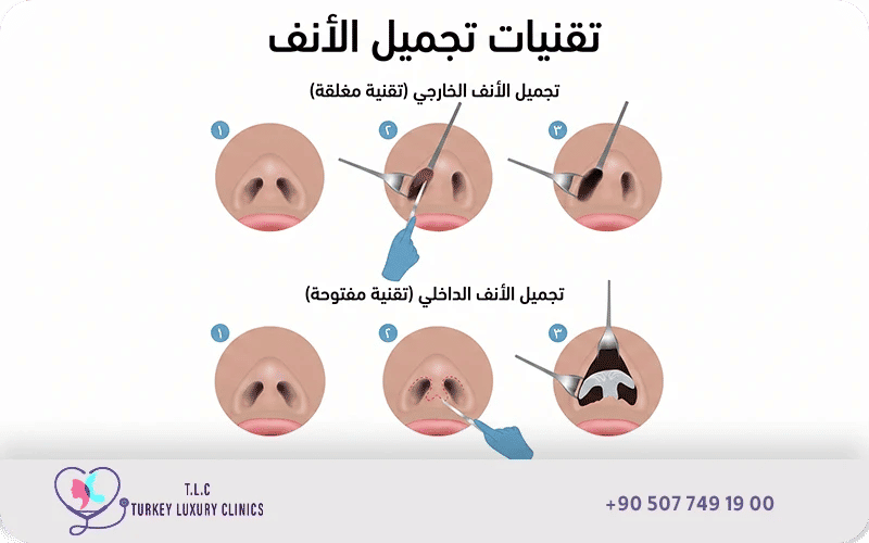 ما هي طرق تصغير الانف جراحياً؟