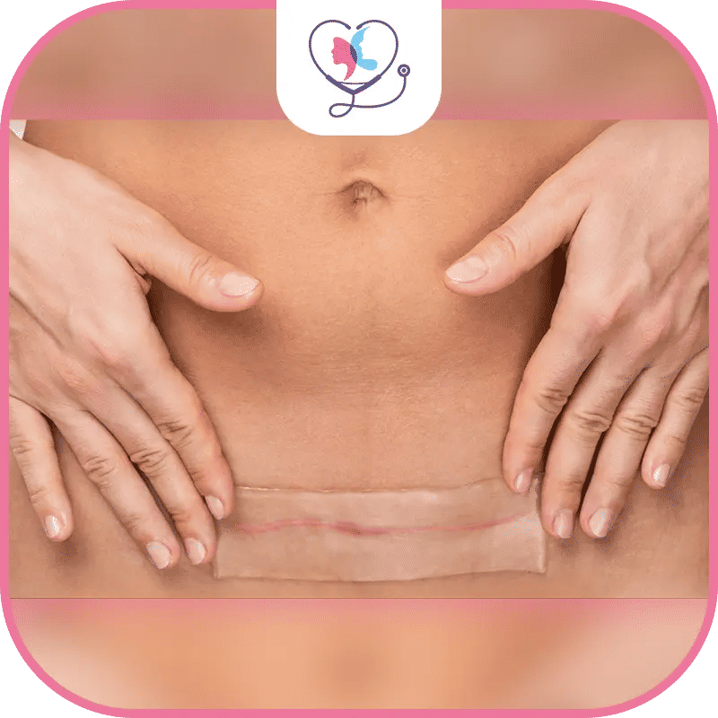 مدة الشفاء من عملية شد البطن