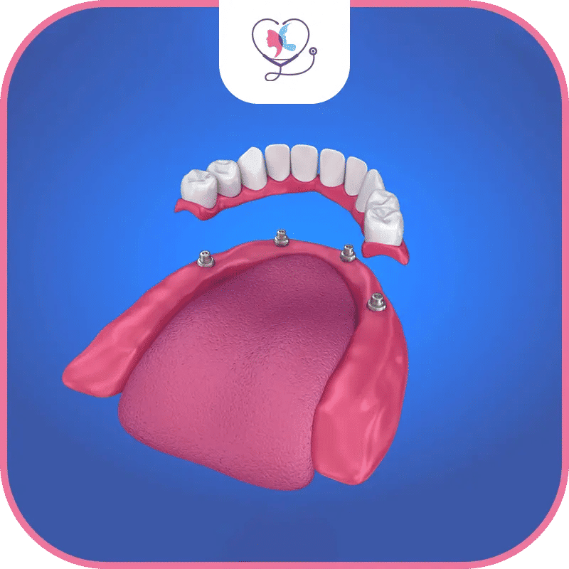 Benefits of Dental Implants for Denture Stabilization