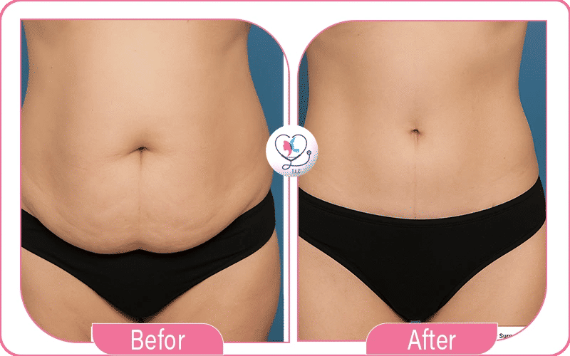 نتائج تجربتي مع عملية نحت الجسم