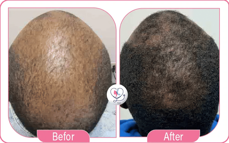 تكلفة تجربتي مع تقنية الخلايا الجذعية للشعر تكلفة تجربتي مع تقنية الخلايا الجذعية للشعر