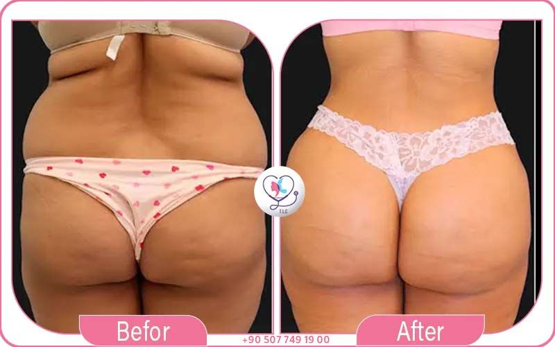 Why It’s Important to Choose an Expert BBL Surgeon