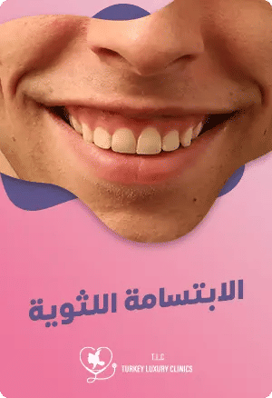 الابتسامة اللثوية: أسبابها وطرق علاجها للحصول على ابتسامة طبيعيةfeatured image