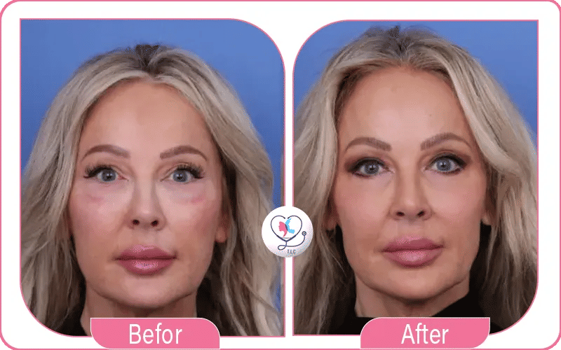 Pinch blépharoplastie avant après