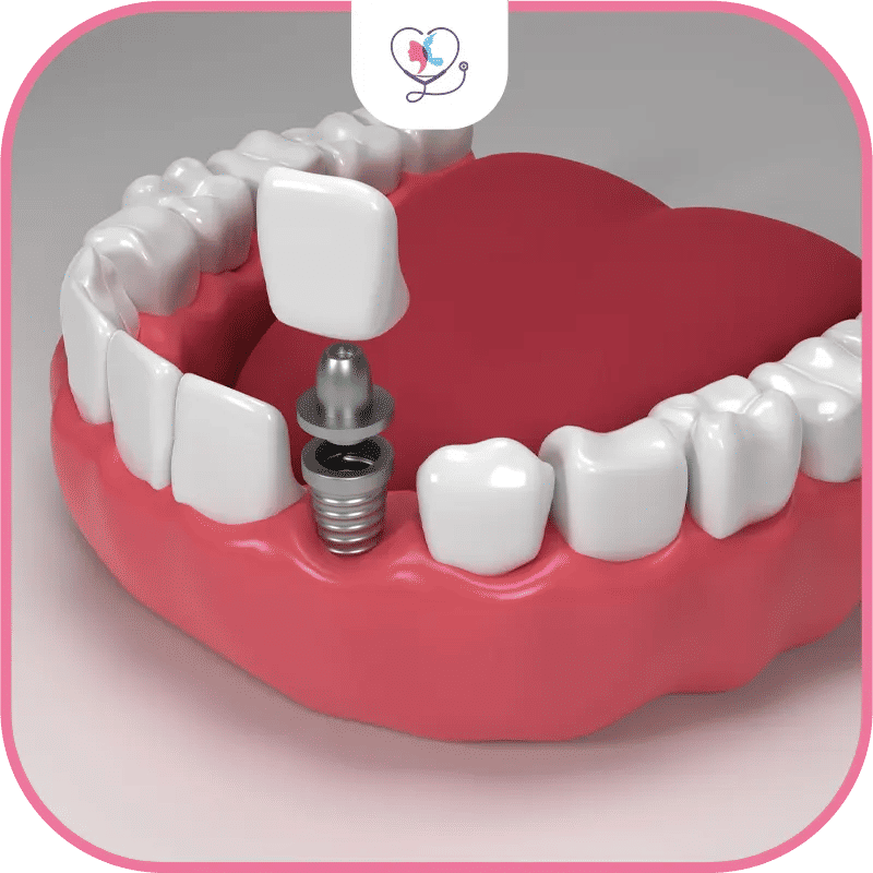 Candidates for Same Day Dental Implants