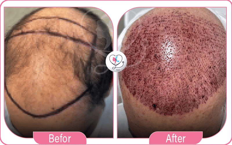 بعد عملية زراعة الشعر بالاقتطاف FUE