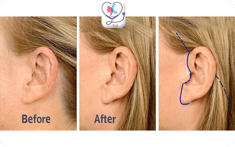 Localisation des Cicatrices après Mini Lifting du Visage