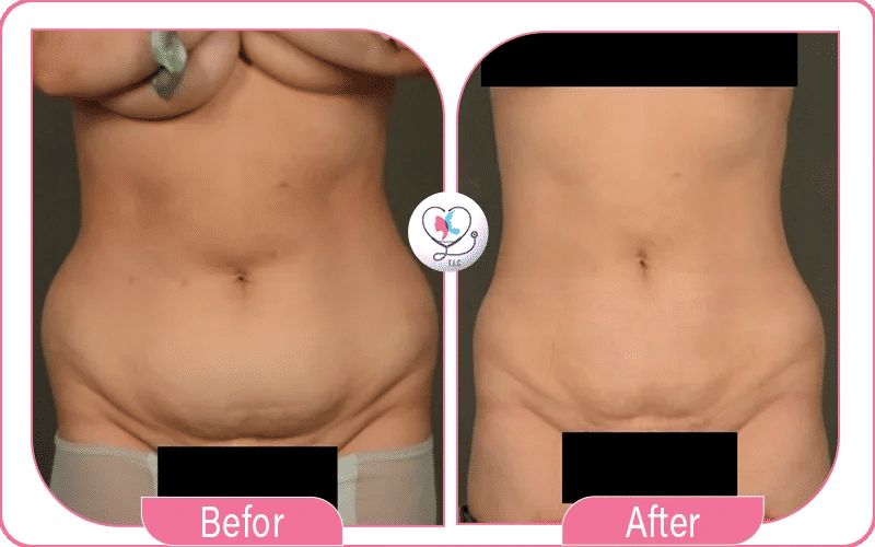 liposuccion douce avant après-2