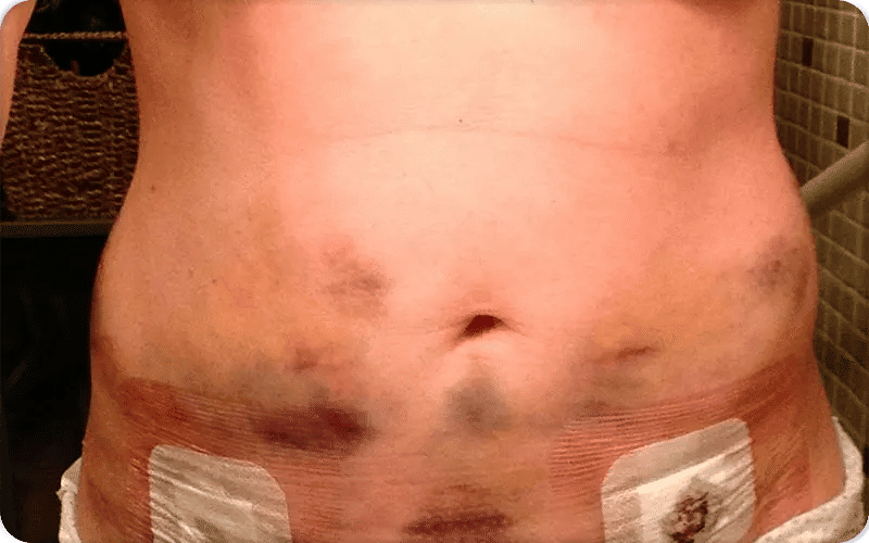 Scarring and Belly Button Appearance