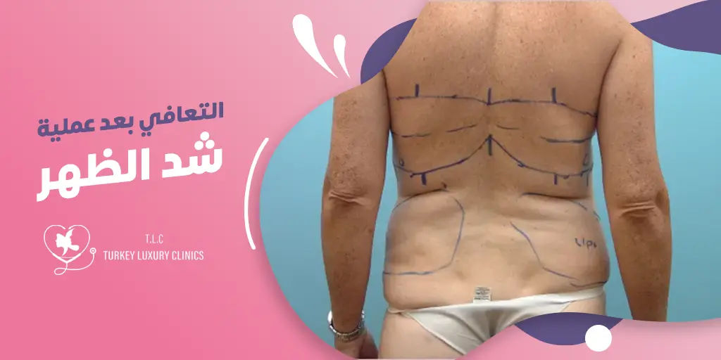 التعافي بعد عملية شد الظهر: الجدول الزمني والنتائج المتوقعة