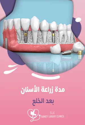 مدة زراعة الأسنان بعد الخلع: 1 ساعة وتزيد حسب الحالة