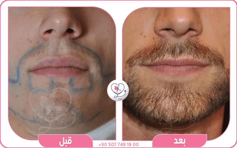 نتائج زراعة شنب قبل وبعد