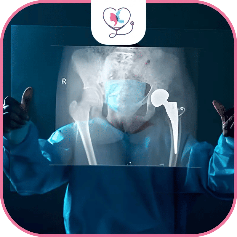 العوامل المؤثرة على تكلفة استبدال مفصل الورك في تركيا