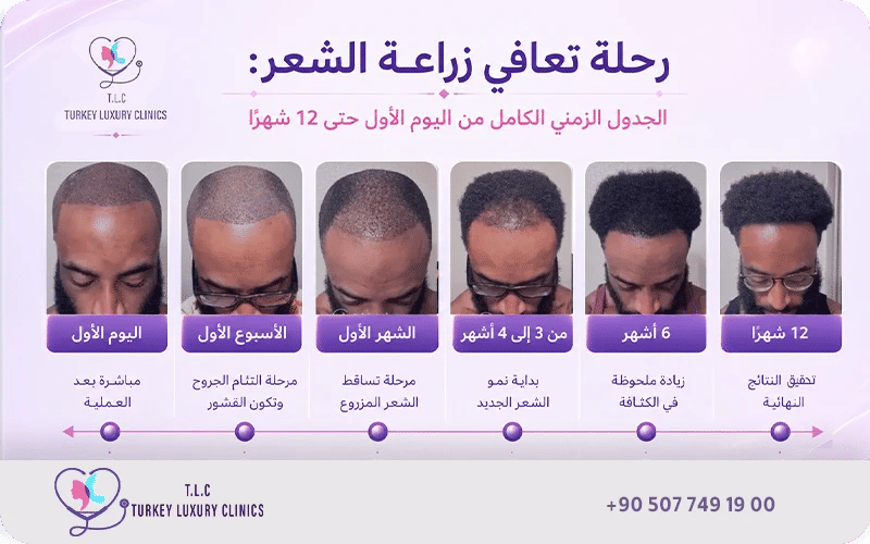 مراحل نمو الشعر بعد الزراعة بالصور