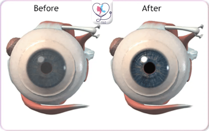 Factors Affecting Success and Longevity of Corneal Grafts
