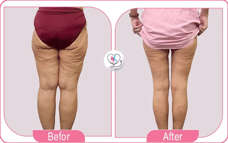 تجربتي مع عملية شد الأفخاذ 4