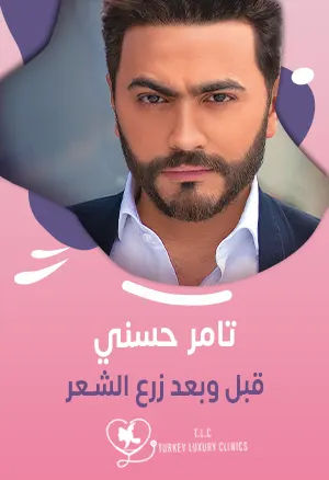 تامر حسني قبل وبعد زرع الشعر: النتائج بالصور والفيديوfeatured image