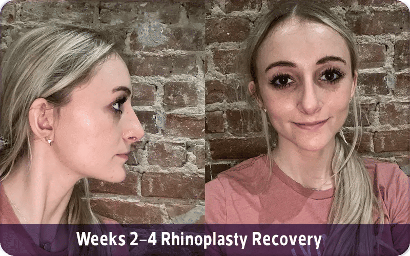Weeks 2–4 Rhinoplasty Recovery with Photos